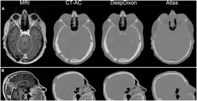 DeepDixon synthetic CT for [18F]FET PET/MRI attenuation correction of post-surgery glioma patients with metal implants